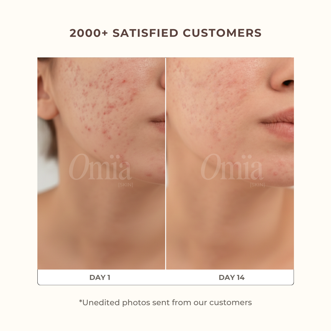 Anti-Blemishes Turmeric Pads