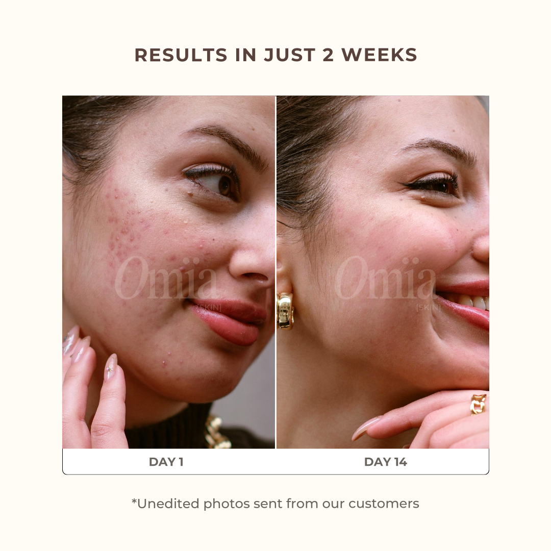 Anti-Blemishes Turmeric Pads